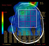Post Operative MR Spectroscopy for GBM