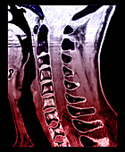 Sickle Cell Osteopathy,CT Scan