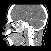 Nasopharyngeal Angiofibroma,CT Scan