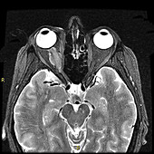 Optic Sheath Meningioma,MRI