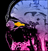 Optic Sheath Meningioma,MRI