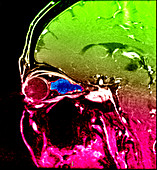 Optic Sheath Meningioma,MRI