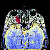 Optic Sheath Meningioma,MRI