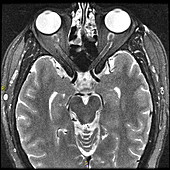 Optic Neuritis,MRI