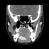 Lingual Thyroid,CT Scan