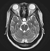 Pseudotumour Cerebri,MRI