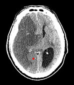 Large Stroke,CT Scan