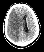 Large Stroke,CT Scan