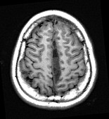 Sinusitis Complicated by Empyema,MRI