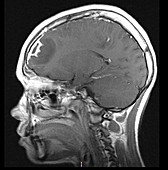 Sinusitis Complicated by Empyema,MRI