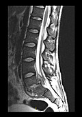 Epidural Abscess,MRI