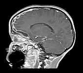 Sinusitis with Empyema,MRI