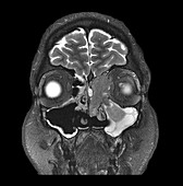 Squamous Cell Cancer of Ethmoids,MRI