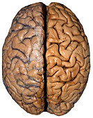 Brain,Gross Specimen