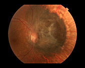 Choroidal Melanoma