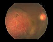 Retinal Hemangioma