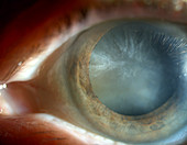 Cataract