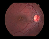 Crystalline Maculopathy