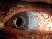 Corneal Implant