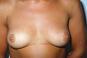 Nulliparous Female Breasts