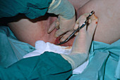 Episiotomy