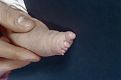 Congenital Deformity of the Foot