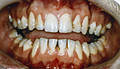 Crowded Teeth Before Treatment