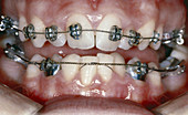 Braces for Crowded Teeth