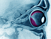 Retinal Detachment,MRI