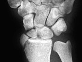 Wrist Fractures,X-ray
