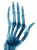 Rheumatoid Arthritis,X-ray