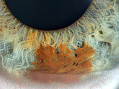 Iris Nevus