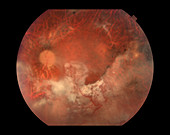 Cytomegalovirus Retinitis