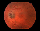 Melanoma of the Optic Nerve