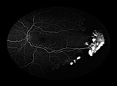 Sickle Cell Retinopathy