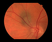 Choroidal Nevus