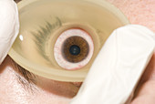 UBM Scan of Eye
