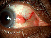 Ocular Surface Tumour