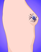 Breast Cancer,Illustration