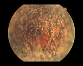 Asteroid Hyalosis,Ophthalmic Medicine