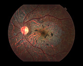 Macular Dystrophy,Ophthalmic Medicine