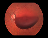 Sub ILM Hemorrhage,Ophthalmic Medicine