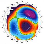 Astigmatism,Ophthalmic Medicine