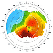 Astigmatism,Ophthalmic Medicine