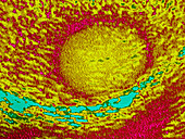 Ultrasound showing Testicular Cancer