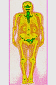 Obese Person,Gamma Scan