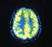 PET Scan of Normal Brain