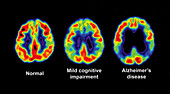 Normal,Impaired and Alzheimer Brains