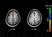 Schizophrenia,MRI Scans