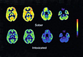 Sober and Intoxicated Brains,PET Scans